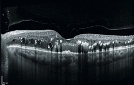 Netzhautlaser (Argon) 6 Optische Kohärenztomographie