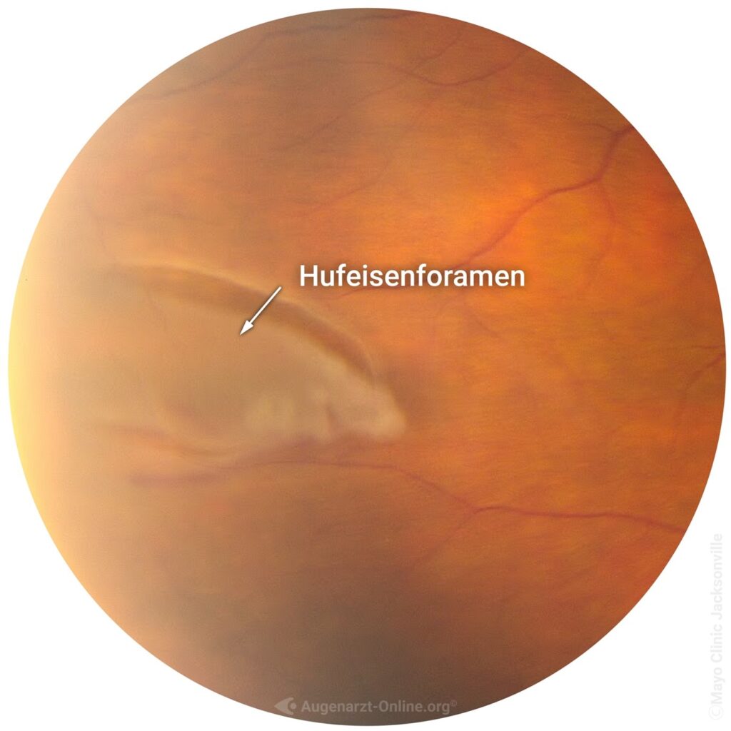 Netzhautlaser (Argon) 1 Bild4