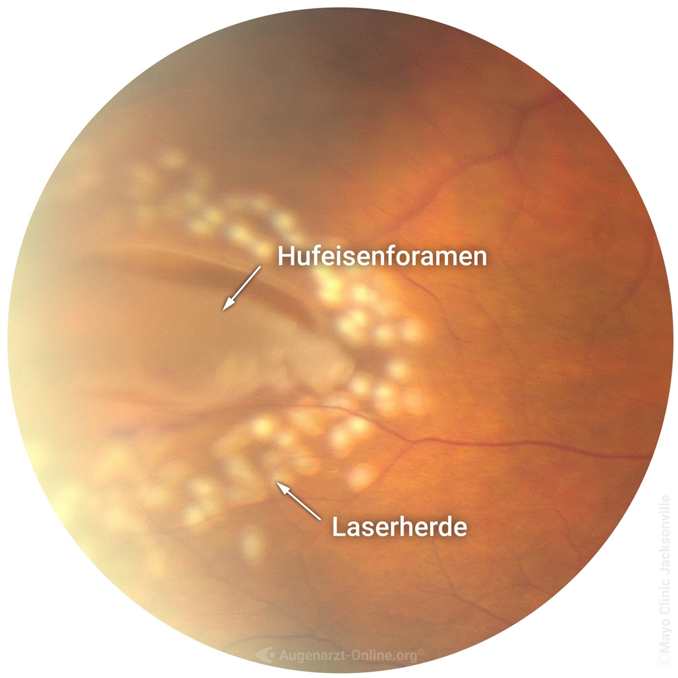 Netzhautlaser (Argon) 2 Bild5