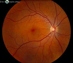 Netzhautlaser (Argon) 3 Gesunder Augenhintergrund