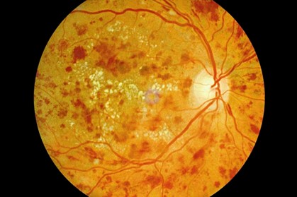 Netzhautlaser (Argon) 4 Diabetische Retinopathie