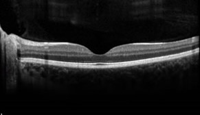 Netzhautlaser (Argon) 5 Optischen Kohärenztomographie